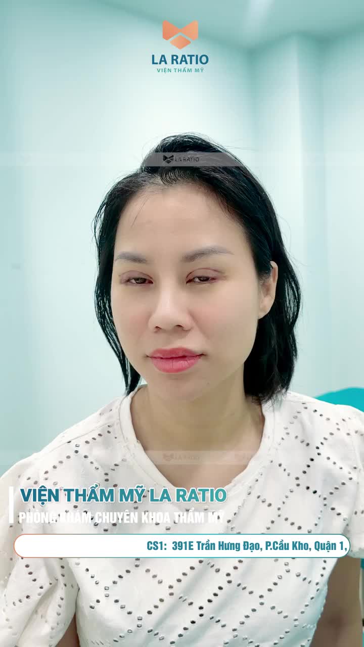 Cắt mí ILID - Cứu tinh của đôi mắt một mí - Sự hài lòng 100% từ khách hàng cắt mí ILID nhà La Ratio