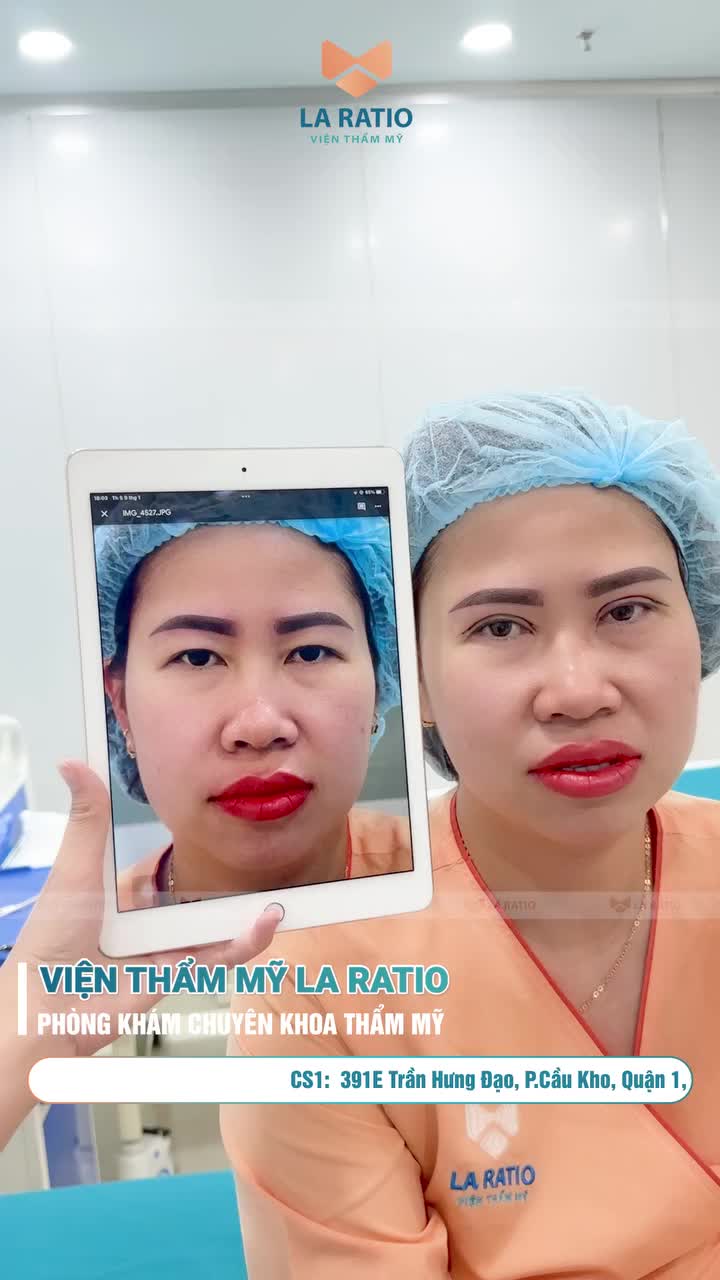 Câu chuyện người thật - việc thật từ khách hàng sau khi đã sử dụng dịch vụ cắt mí ILID tại viên thẩm mỹ La Ratio