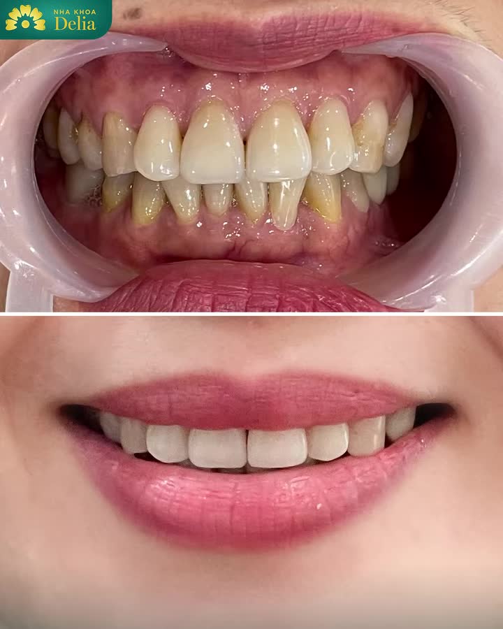 RĂNG MỚI CƯỜI SANG, CẢ NĂM RẠNG NGỜI