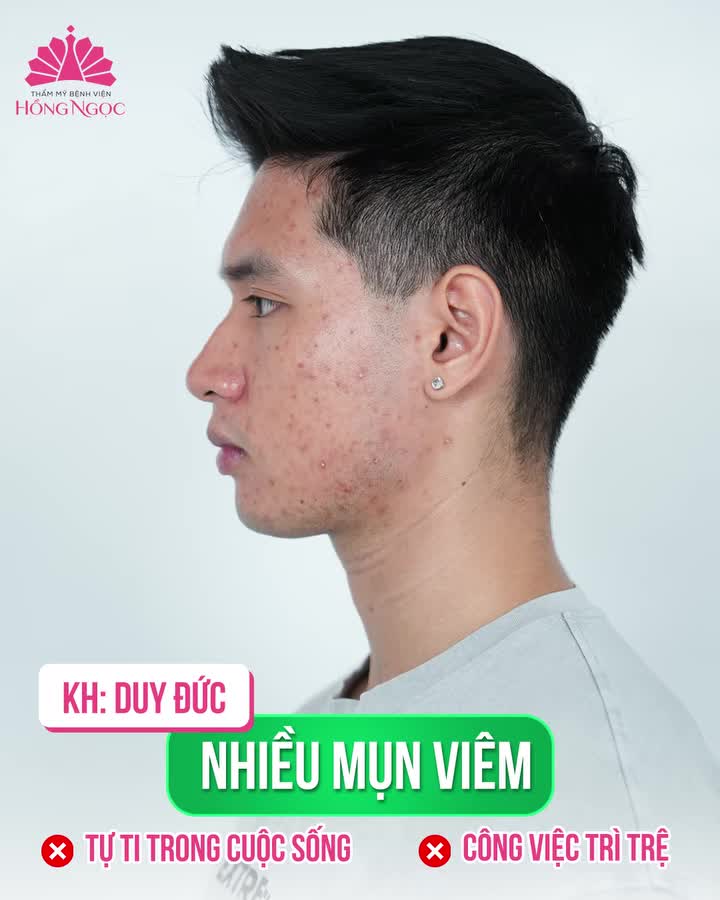SẠCH MỤN - X2 THẦN THÁI TỰ TIN
