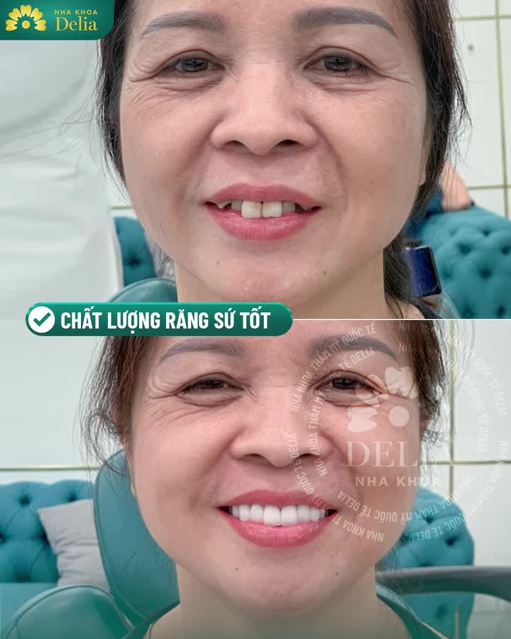 Chị Đặng Thị Nga ( ở Thanh Xuân, Hà Nội) tự tin với nụ cười xuân sau làm răng sứ HT Smile Đức cao cấp