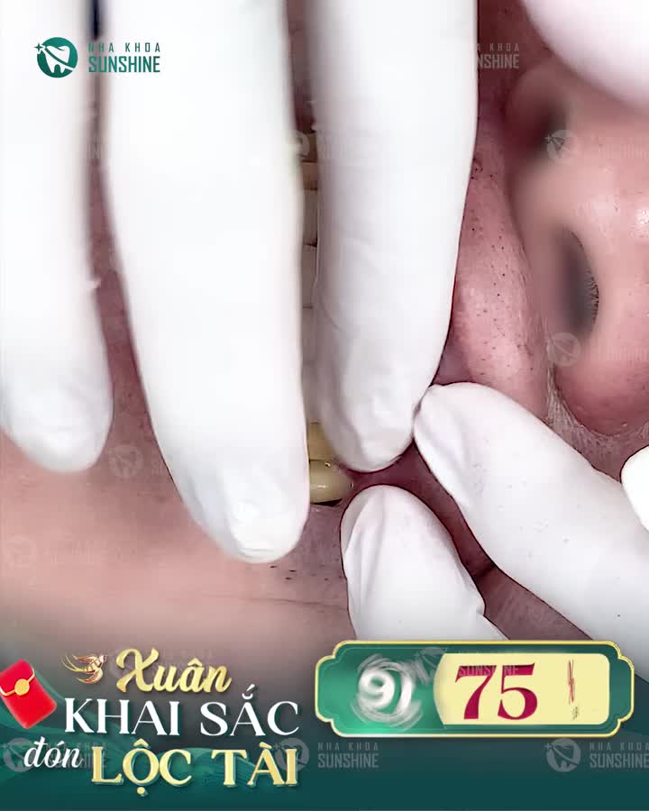 Gói combo 16 răng sứ cao cấp với ưu đãi lên đến 75% Chỉ còn lại 10 SUẤT CUỐI CÙNG cho khách hàng đặt lịch sớm nhất!