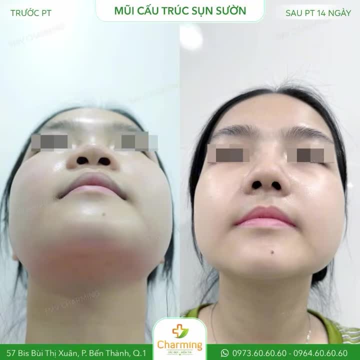 Sau khi được bác sĩ thăm khám, nàng đã lựa chọn phương pháp nâng mũi cấu trúc sụn sườn, giúp định hình lại dáng mũi một cách tự nhiên và bền vững.