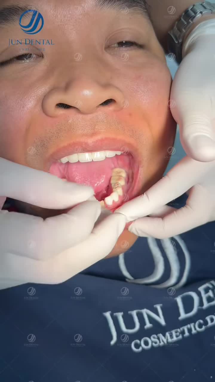 Cười đẹp mà răng chưa đẹp thì phải làm sao?