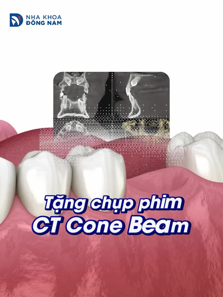 TẶNG GÓI TRỢ GIÁ IMPLANT 20 TRIỆU CÙNG 6 ĐẶC QUYỀN VIP Chỉ áp dụng cho khách hàng để lại SĐT