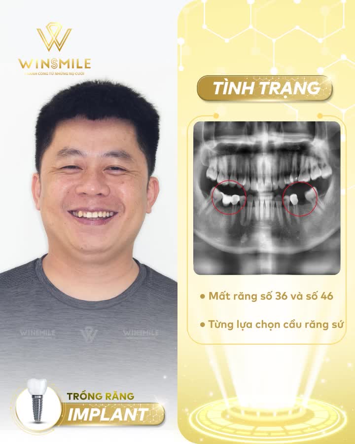 TRẢI NGHIỆM ĂN NHAI SAU KHI “GIÃ TỪ” CẦU RĂNG SỨ