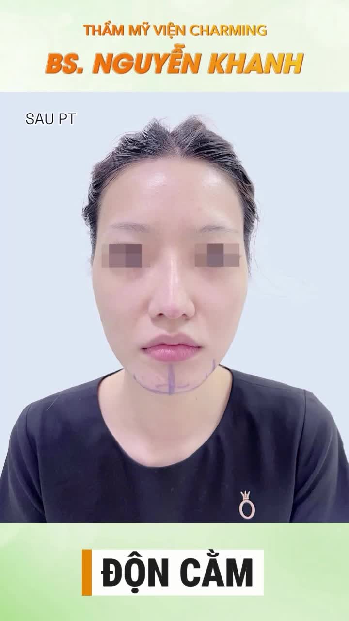 Nhìn vào hình ảnh trước phẫu thuật, nàng khách có phần cằm hơi ngắn và thiếu độ nhô, làm tổng thể gương mặt trông hơi vuông và thiếu sự hài hòa. Tuy đường nét vẫn ưa nhìn nhưng chưa thực sự thanh thoát.