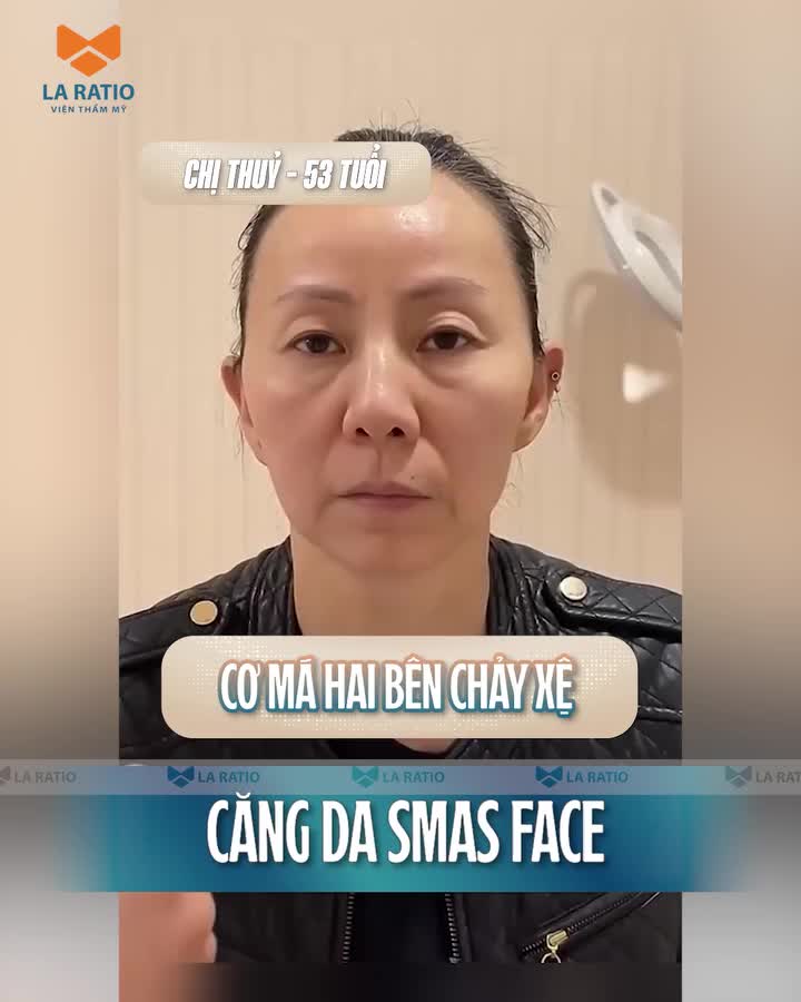 Căng da mặt Smas Face -  Phương pháp trẻ hóa đánh bại sự tàn phá của thời gian