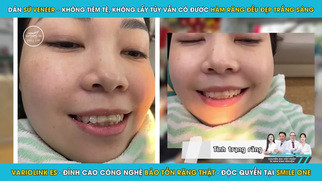 Bạn muốn có nụ cười trắng sáng, tự nhiên nhưng ngại đau, ngại mài răng?
