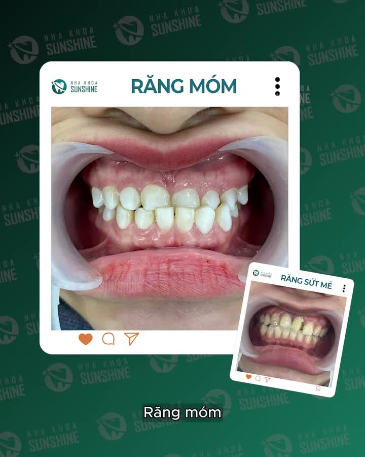 RĂNG KHẤP KHỂNH – RĂNG XỈN MÀU – RĂNG SỨT MẺ - RĂNG THƯA – RĂNG HÔ/MÓM