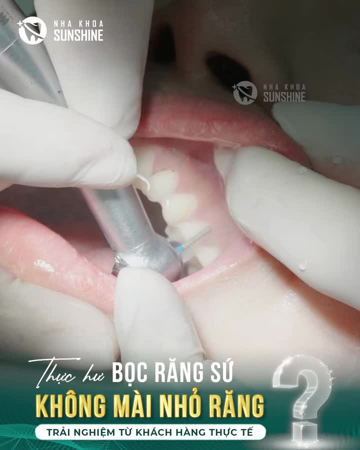 THỰC HƯ BỌC RĂNG SỨ KHÔNG MÀI NHỎ RĂNG