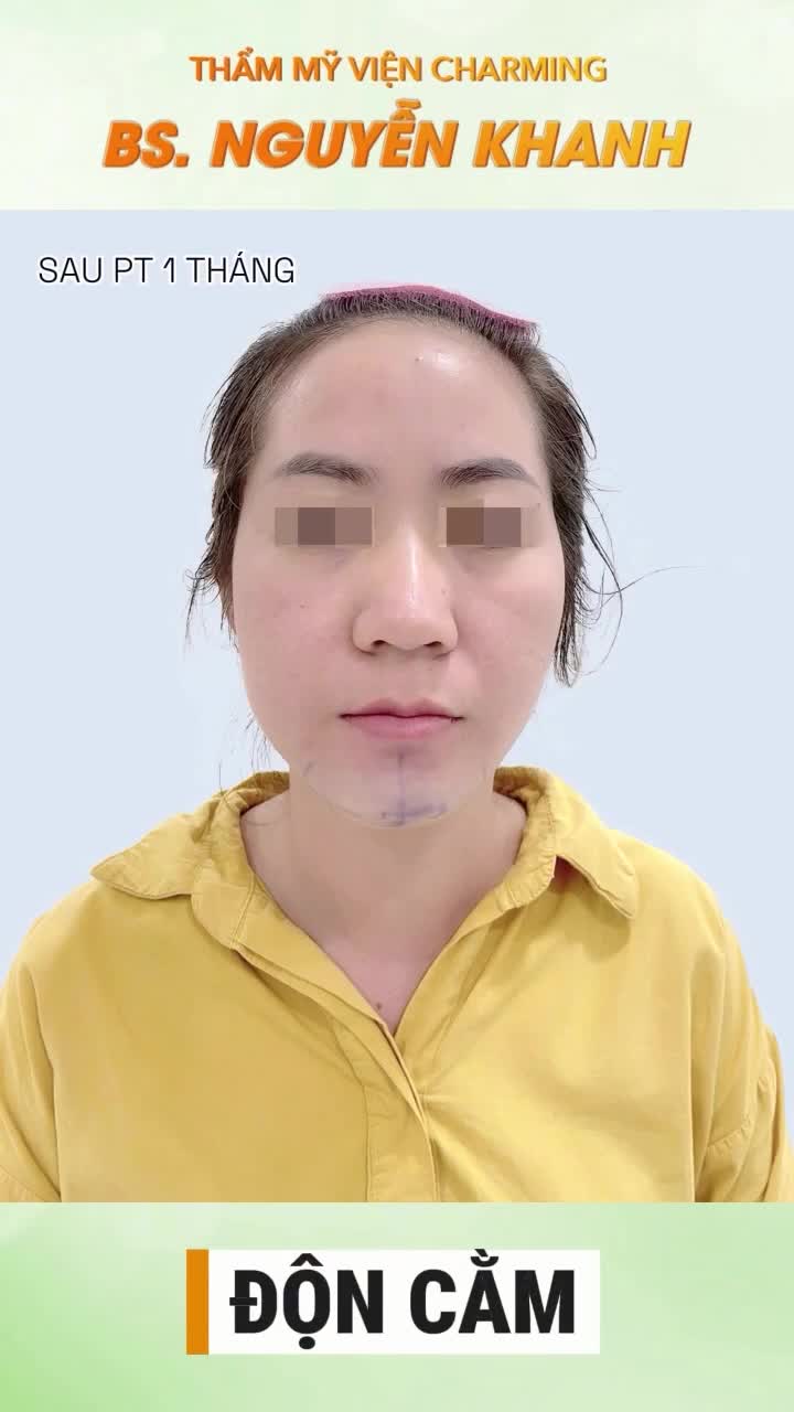 Trước khi thực hiện độn cằm, đường nét gương mặt của khách còn thiếu một chút cân đối do phần cằm hơi ngắn và hụt nhẹ về phía sau.