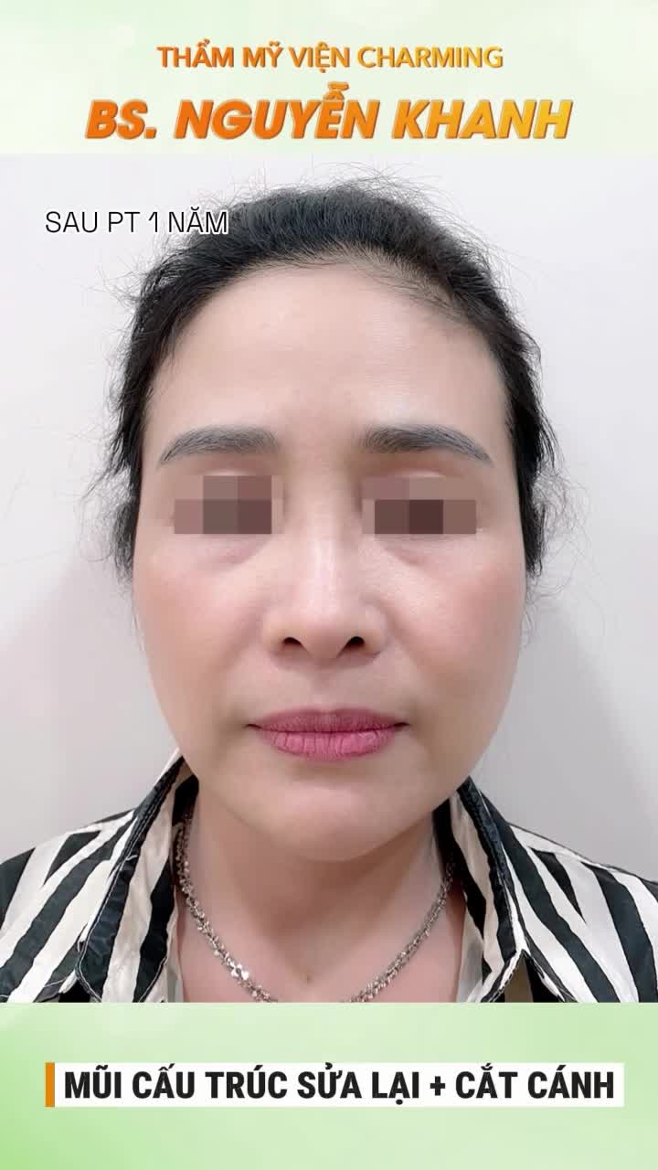 Trước khi đến Charming, chiếc mũi cũ khiến chị nhiều lần mất tự tin vì sóng mũi thấp, đầu mũi hơi to và cánh mũi bè làm tổng thể gương mặt thiếu hài hòa.