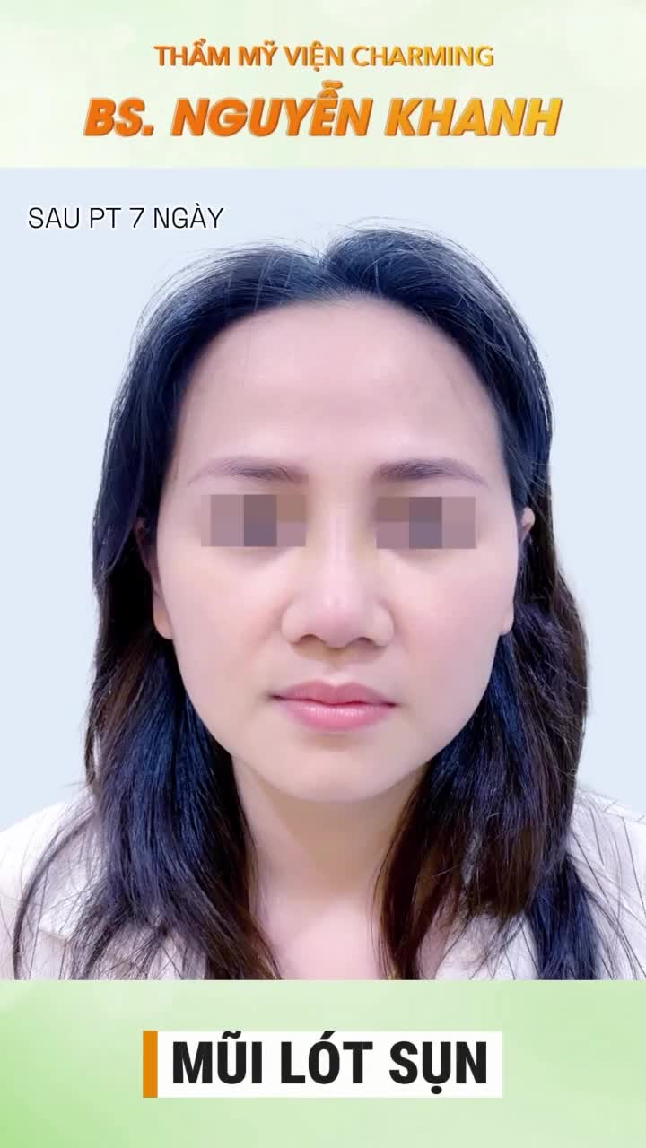 Nhìn nàng khách sau khi nâng mũi lót sụn tại Charming, ai cũng phải trầm trồ bởi nét đẹp vừa thanh tú lại rất tự nhiên. Chiếc mũi được nâng cao nhẹ nhàng, sóng mũi thẳng và mềm mại, hài hòa tuyệt vời với gương mặt.