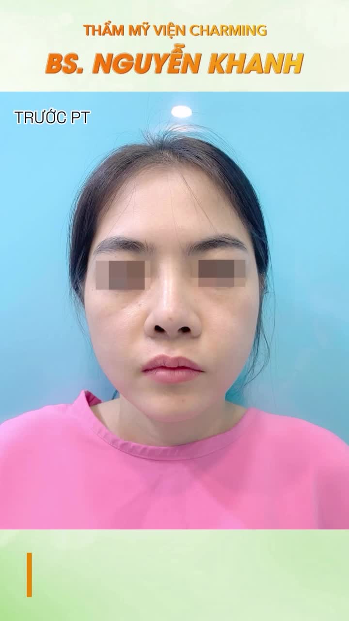Sau khi thực hiện nâng mũi cấu trúc sụn sườn kết hợp cắt xương và cắt cánh mũi tại Charming, nàng khách đã sở hữu dáng mũi mềm mại và thanh thoát hơn rất nhiều. Phần sóng mũi được dựng thẳng tự nhiên, sống động từ mọi góc nhìn.