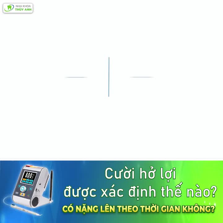 Cười hở lợi được xác định thế nào và có nặng lên theo thời gian không?