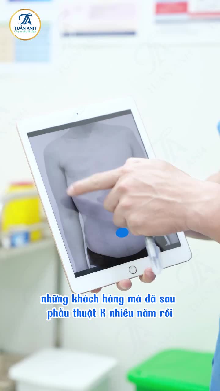 Tạo hình thẩm mỹ V1 cho chị Kh đã phẫu thuật K nhiều năm, hiện tại mong muốn tạo hình lại V1 cân đối đều đẹp cả 2 bên !