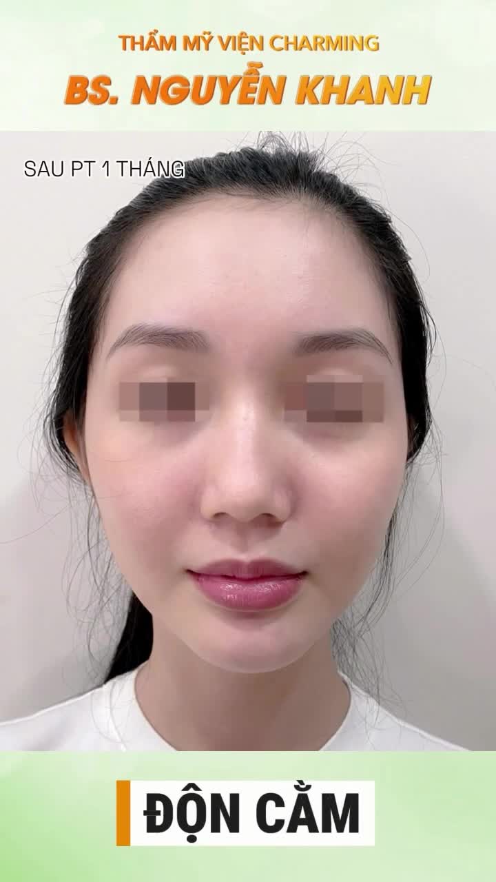 Trước đây, gương mặt của nàng có phần chưa được cân đối do phần cằm hơi ngắn, khiến tổng thể trông kém thanh thoát.