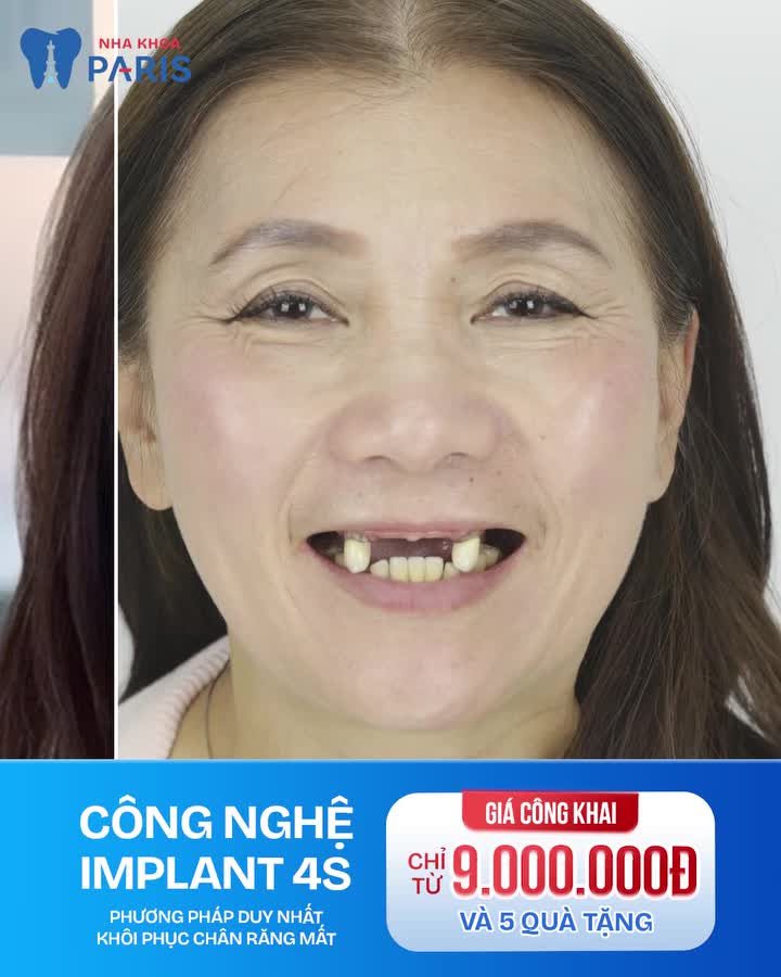 TÌM GẤP 28 ANH CHỊ đang gặp các tình trạng: Mất 1 răng – mất nhiều răng Muốn trồng răng an toàn – bền chắc – đẹp như răng thật