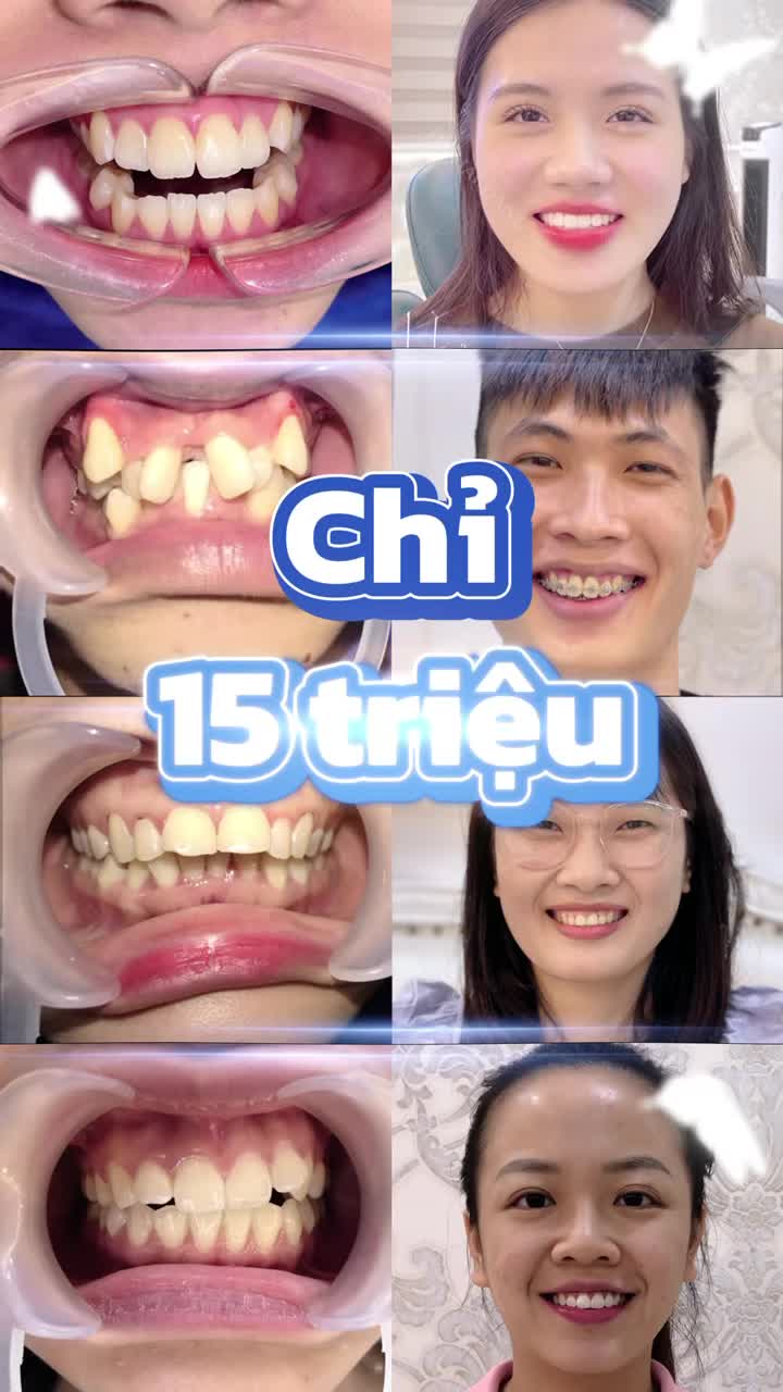 SIÊU ƯU ĐÃI MÙA HÈ – NIỀNG RĂNG CHỈ 15 TRIỆU