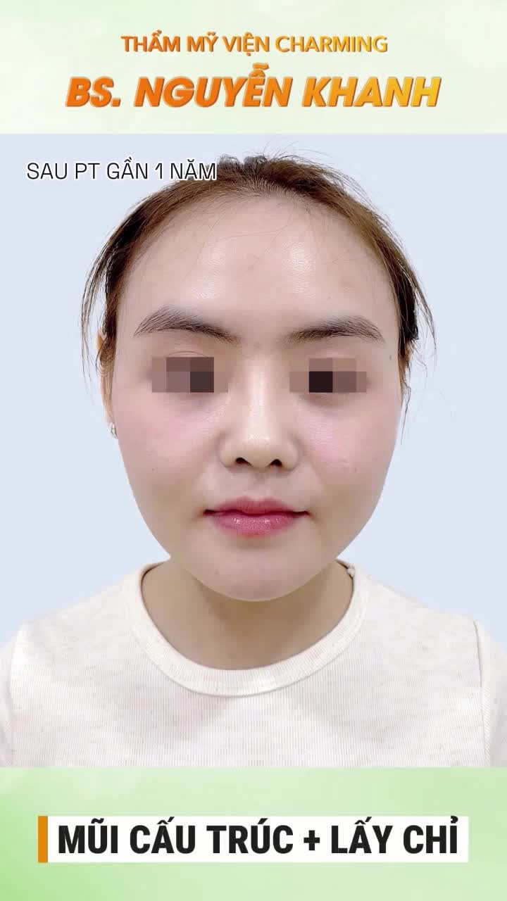 Trước khi đến với Charming, chiếc mũi của nàng có phần hơi thấp và chưa thật sự làm nổi bật các đường nét khuôn mặt.