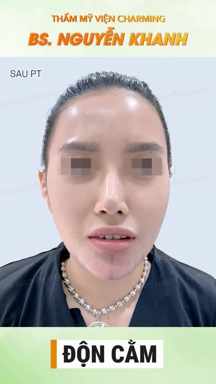 ​​​​​​​Sau phẫu thuật, đường nét khuôn mặt thay đổi một cách tự nhiên.