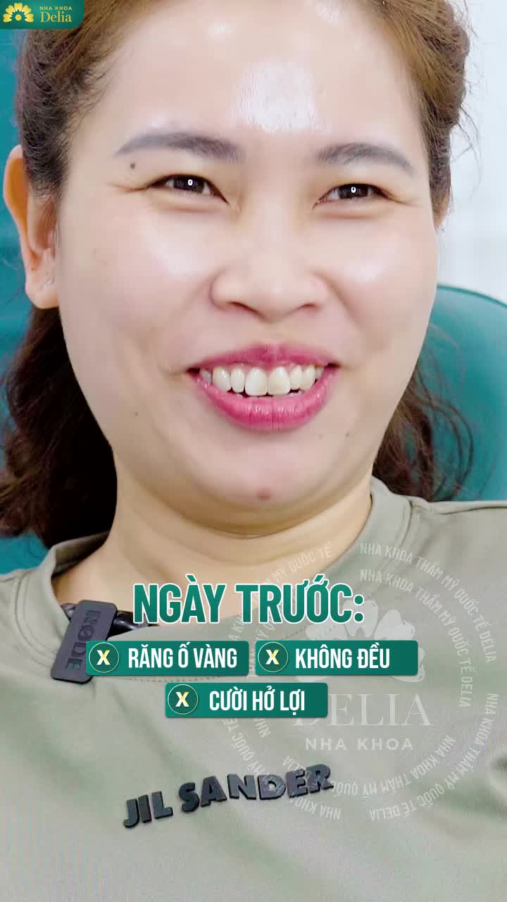 2 năm đắn đo làm răng sứ và 48 giờ thay đổi ngoạn mục