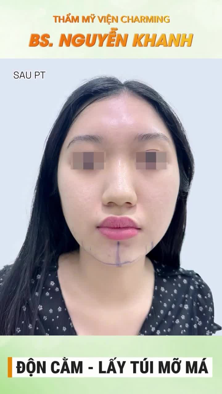 Mọi người nhìn hình cũng đủ thấy, sau 1,5 năm, dáng cằm của khách vẫn giữ được sự hài hòa, không xô lệch hay biến dạng.