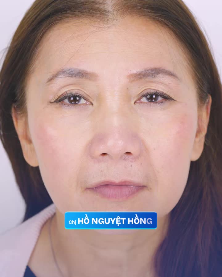 LỘT XÁC NỤ CƯỜI NHỜ CÔNG NGHỆ TRỒNG RĂNG THẨM MỸ TỪ CHÂU ÂU