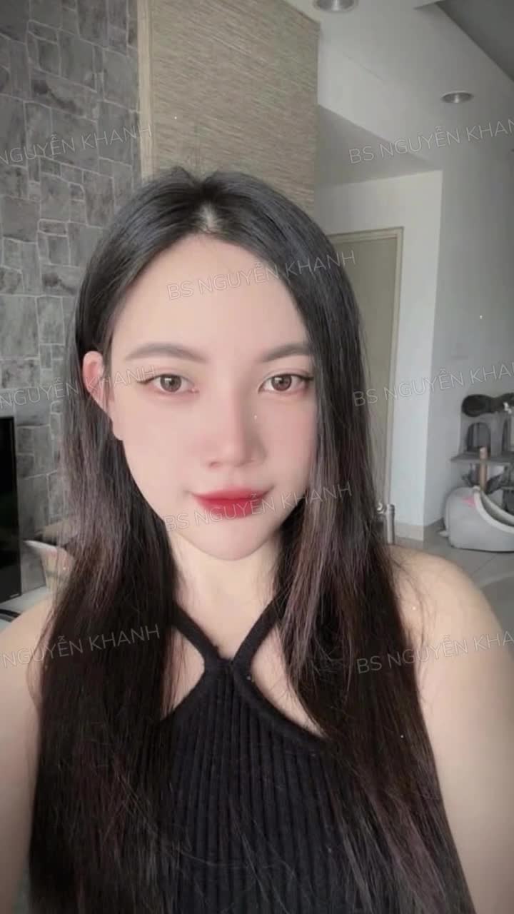 Sau 1 tháng độn cằm, nàng khách đã sở hữu diện mạo hài hòa hơn với đường nét gương mặt thanh thoát, trẻ trung.