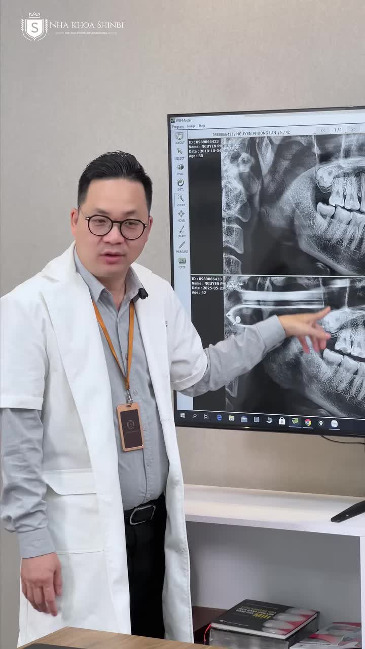 TRƯỜNG HỢP KHÔNG CHỈ ĐỊNH NHỔ RĂNG SỐ 8