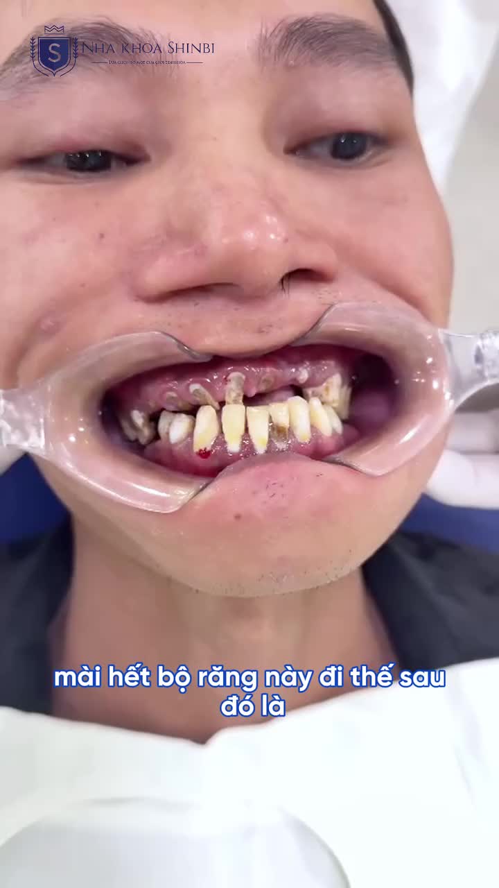 TÁI SINH HÀM RĂNG CHO NGƯỜI HÚT THUỐC LÁ LÂU NĂM