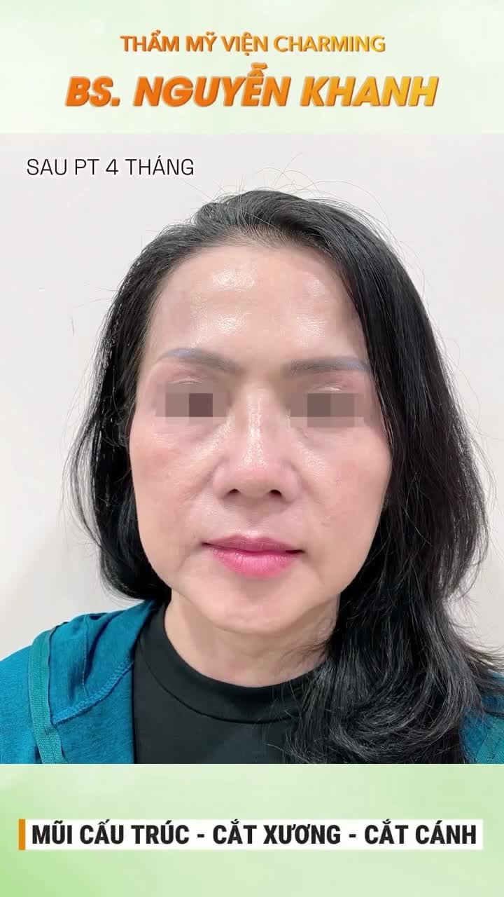 Sau 4 tháng, dáng mũi trở nên thanh thoát và hài hoà hơn với tổng thể gương mặt, mang lại cảm giác trẻ trung rõ rệt.
