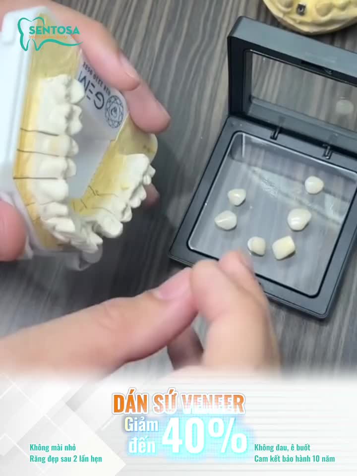 DÁN SỨ VENEER - PHƯƠNG PHÁP PHỤC HÌNH KHÔNG MÀI NHỎ RĂNG