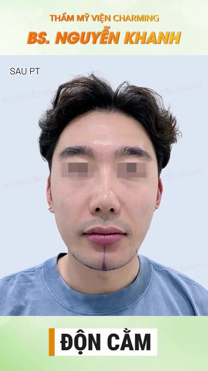 Trước khi đến Charming, gương mặt chàng có phần chưa thật sự cân đối do dáng cằm hơi ngắn, làm tổng thể nghiêng nhẹ về phía trên.