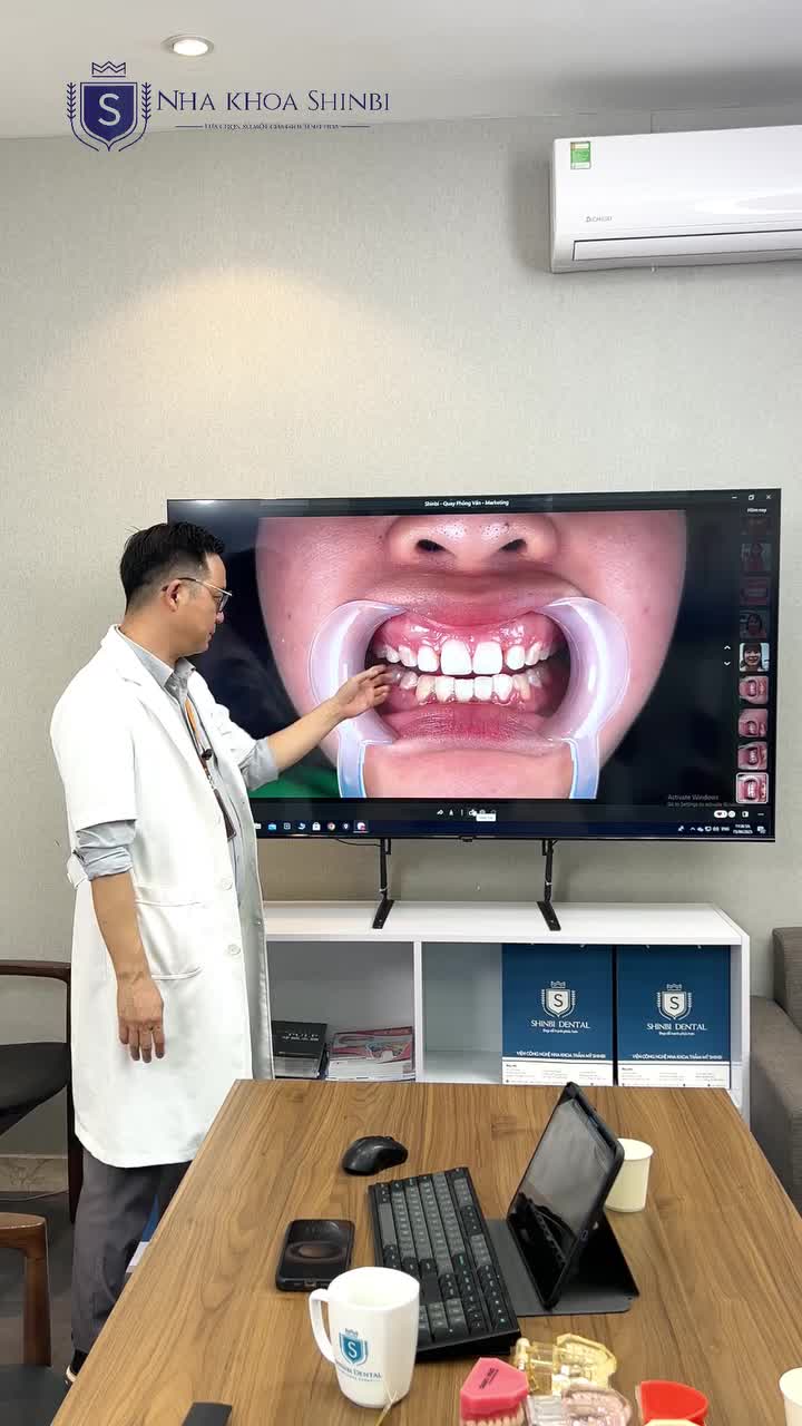 GIẢI PHÁP THẨM MỸ ÍT XÂM LẤN CHO RĂNG THƯA