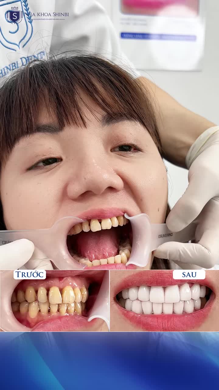 DÁN SỨ VENEER PHỤC HÌNH RĂNG ĐẸP HOÀN HẢO – BẢO TỒN RĂNG THẬT TỐI ĐA