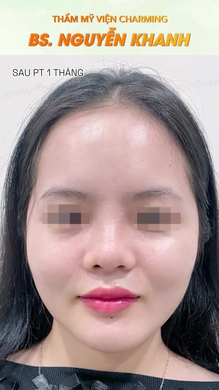 Chỉ sau 1 tháng nâng mũi lót sụn kết hợp độn cằm tại Charming, diện mạo nàng như được “nâng cấp” trọn vẹn.
