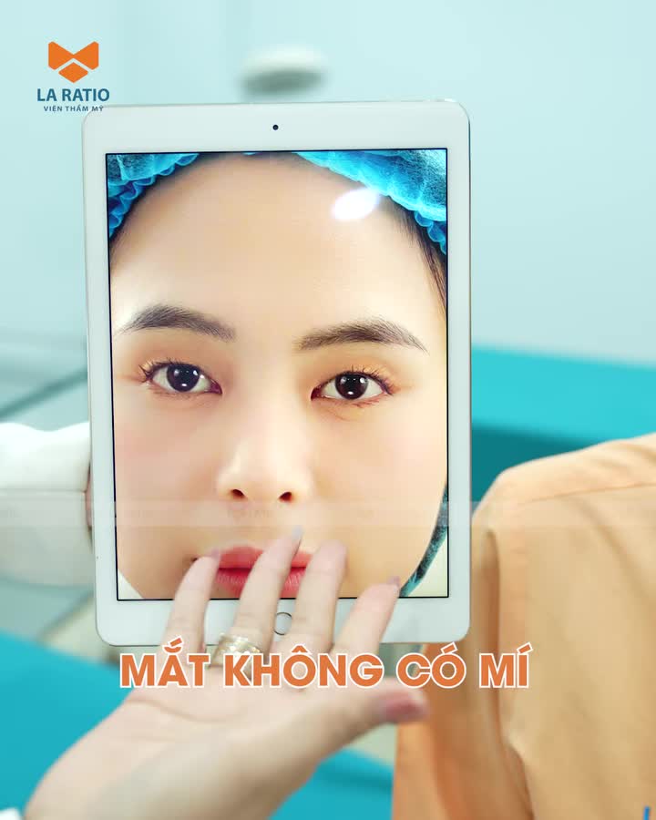 Công nghệ mí iLid – Giải pháp cho đôi mắt sụp nhẹ, mệt mỏi