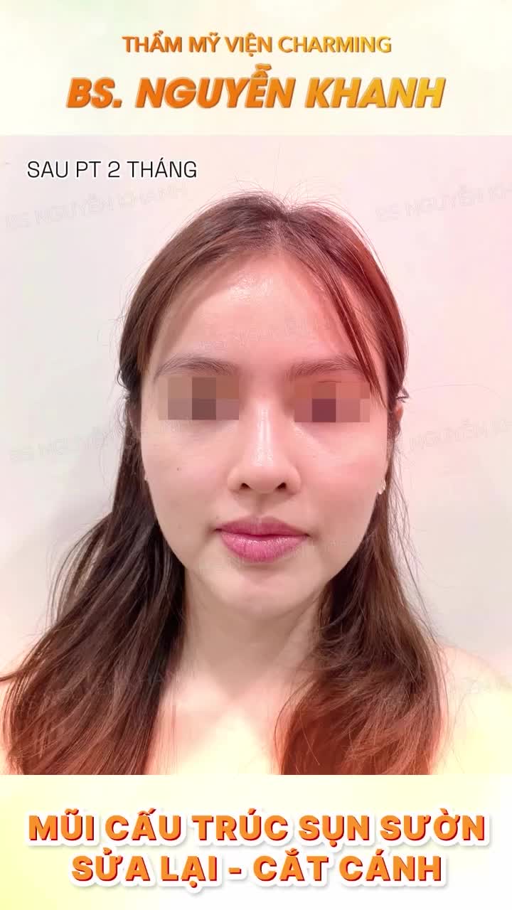 Chỉ sau 2 tháng, dáng mũi đã ổn định, thanh tú hơn, cánh mũi gọn lại rõ rệt. Gương mặt vì thế cũng trở nên cân đối, sáng và mềm mại hơn.
