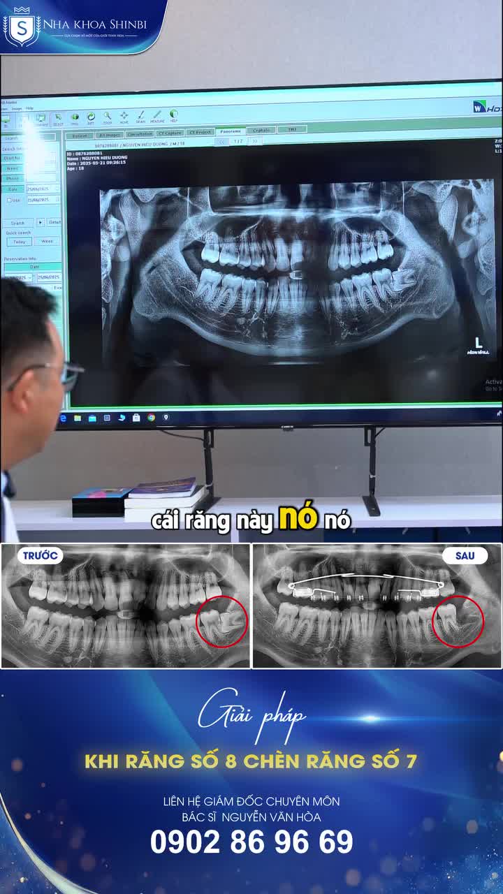 SỰ NGUY HIỂM CỦA RĂNG SỐ 8 CHÈN RĂNG SỐ 7