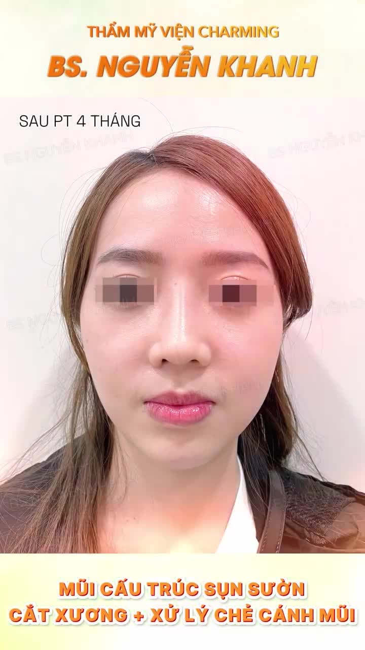 Trước khi đến Charming, nàng khách có sống mũi thấp, đầu mũi tròn và hai bên cánh mũi bị chẻ nhẹ, khiến tổng thể khuôn mặt kém thanh thoát hơn.