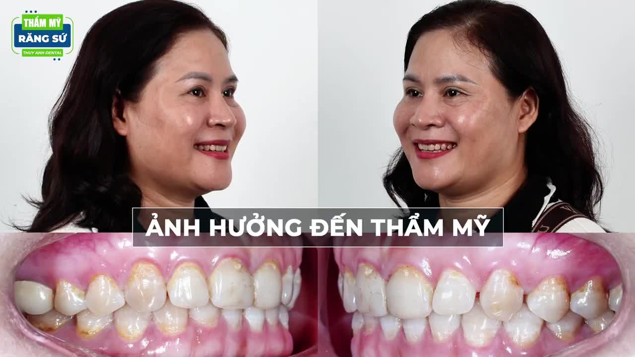 DÁN SỨ VENEER - GIẢI PHÁP HOÀN HẢO CHO NỤ CƯỜI CỦA BẠN