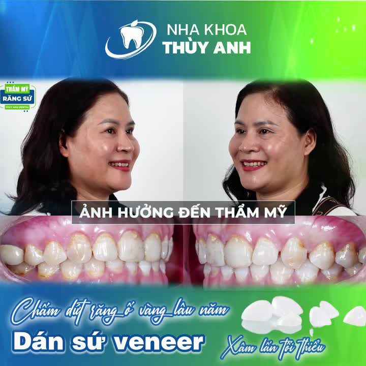 SỢ ĐAU, SỢ MÀI RĂNG VÀ GIẢI PHÁP DÁN SỨ VENEER XÂM LẤN TỐI THIỂU CHO NỤ CƯỜI TỎA SÁNG