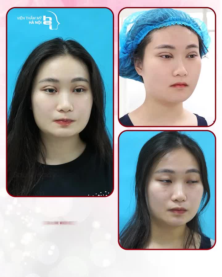 NHẤN MÍ OVAL LINE WIDE DEEP