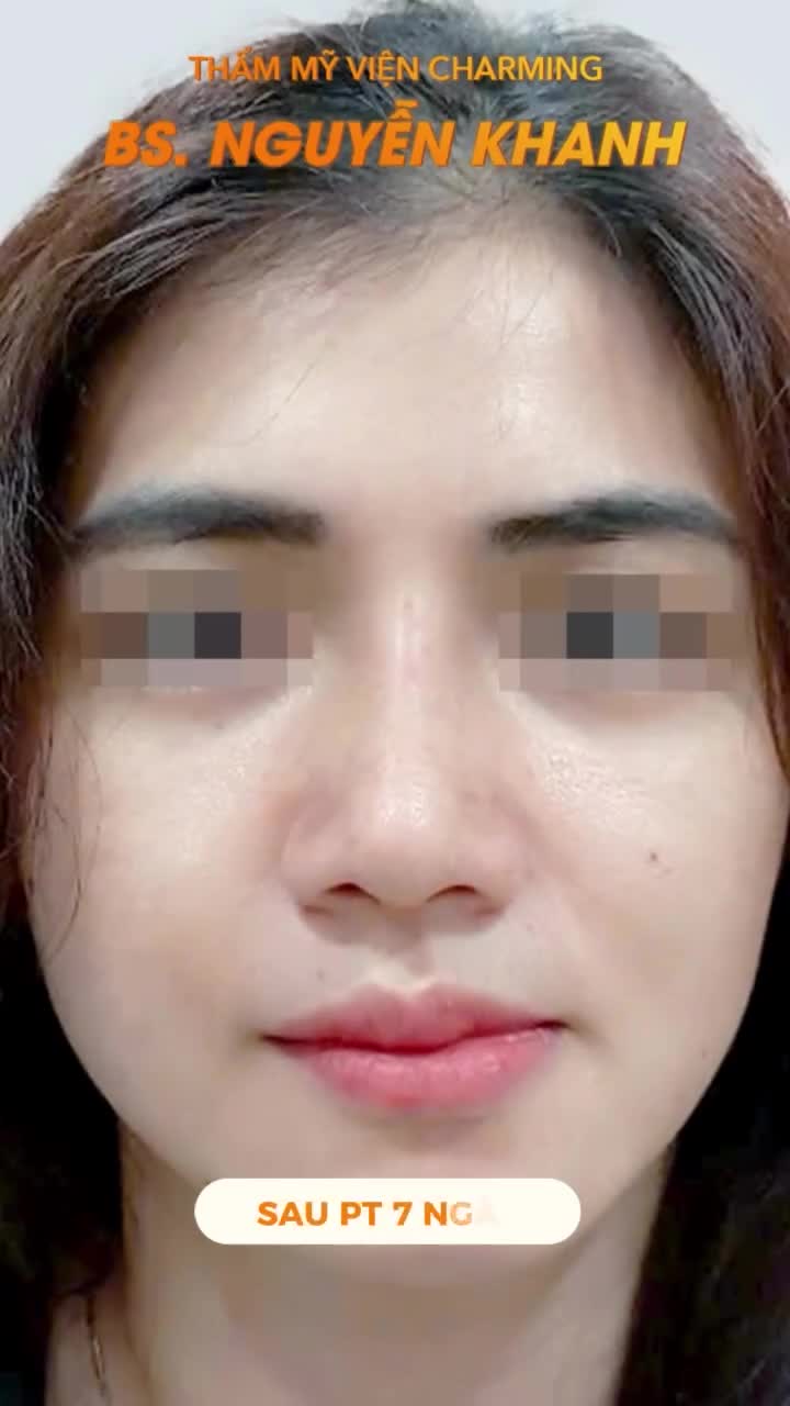 Sau khi thực hiện nâng mũi lót sụn kết hợp thu gọn chóp, cắt xương và chỉnh gồ mổ hở, đường nét khuôn mặt nàng cân đối và mềm mại hơn hẳn.