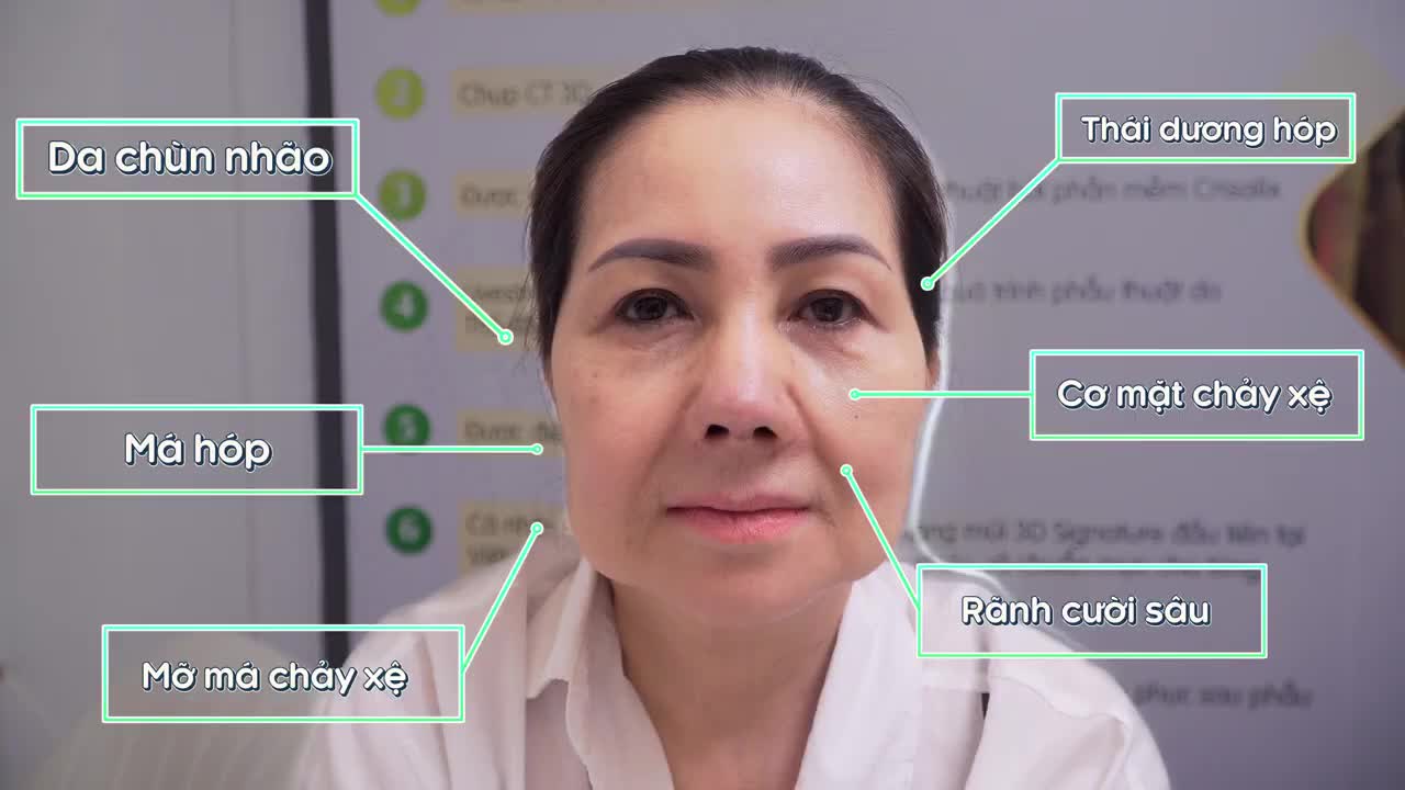 MÃN NHÃN VỚI MÀN THAY ĐỔI NGOẠN MỤC VỚI DEEP PLANE FACELIFT CỦA CÔ KHÁCH HÀNG U50 TẠI SAIGON VENUS