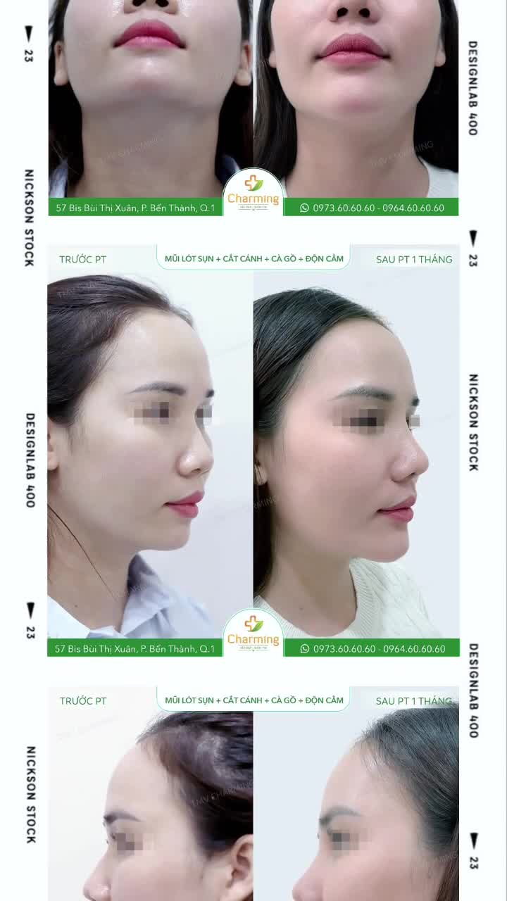 Phẫu thuật nâng mũi lót sụn kết hợp độn cằm và xử lý khuyết điểm đã mang lại cho nàng khách nét đẹp hài hòa, trẻ trung và tự tin hơn trong từng góc nhìn.