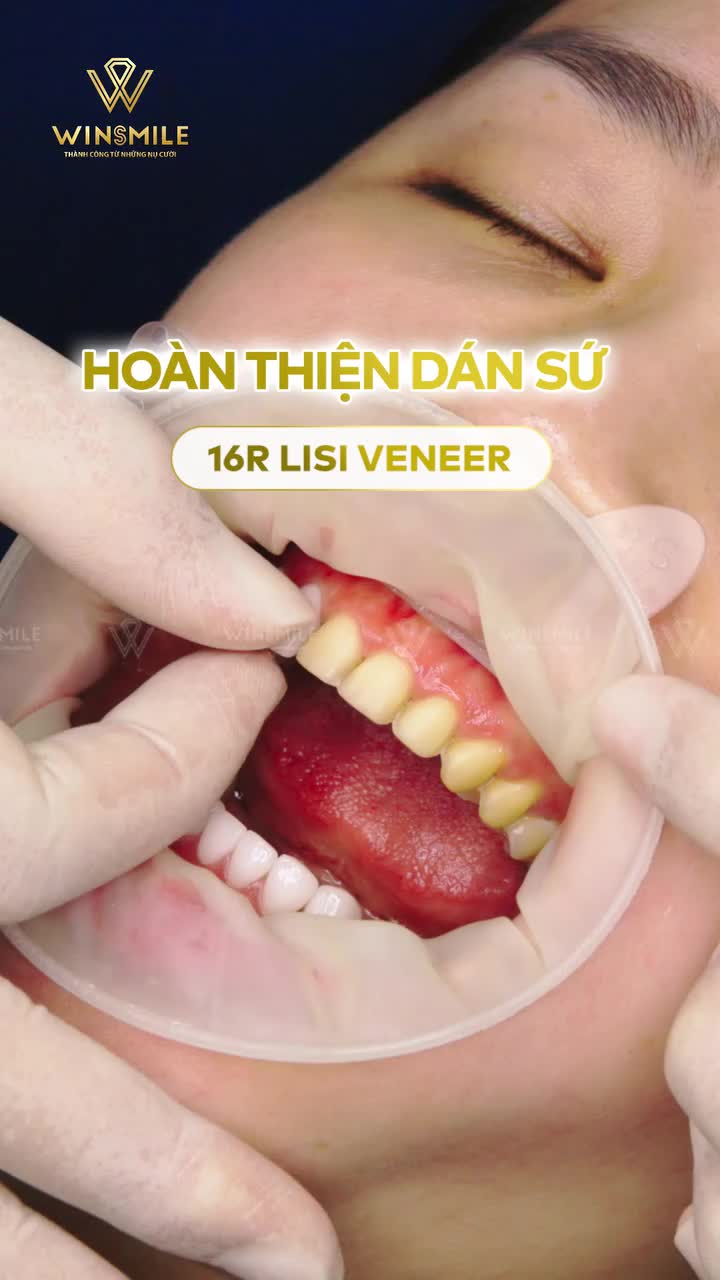 VẺ ĐẸP SIÊU PHẨM TỪ MẶT DÁN SỨ VENEER LISI