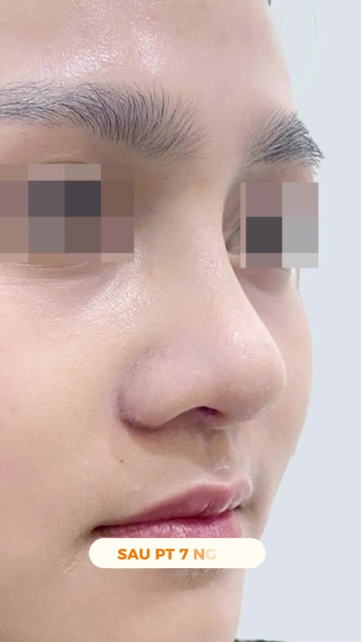 Mũi lót sụn là kỹ thuật nâng mũi được ưa chuộng nhờ khả năng cải thiện dáng mũi mà vẫn đảm bảo độ mềm mại và tự nhiên.